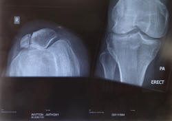 Broken Right Patella